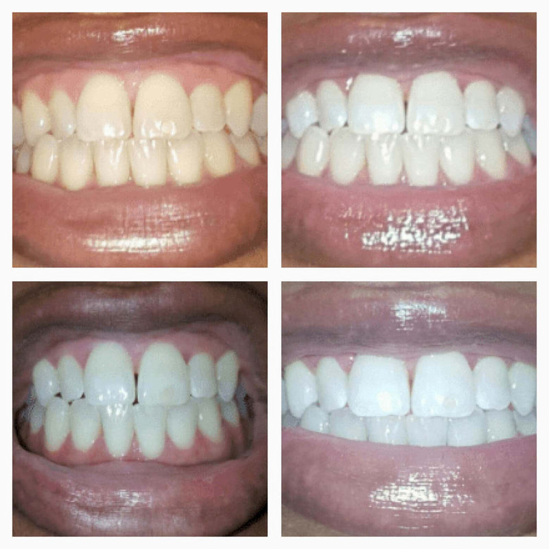 Extra-Strength Teeth Whitening Serum Pen + Dual-Peroxide Formula & Xylitol
